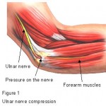 ulnar nerve release